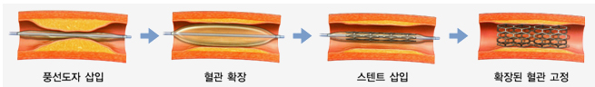 관상동맥 확장술 절차 : 풍선도자 삽입 - 혈관 확장 - 스텐트 삽입 - 확장된 혈관 고정